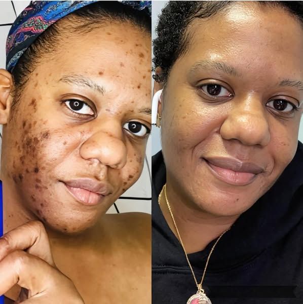 Amaka C. before and after