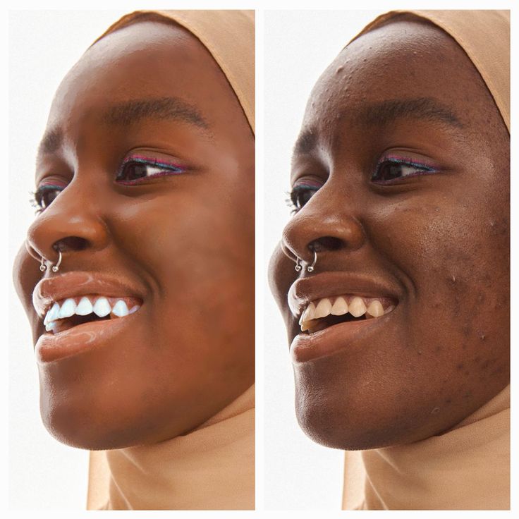 Adaeze O. before and after